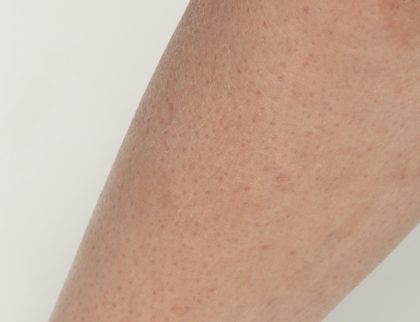 Laser Hair Removal Before & After Patient #435